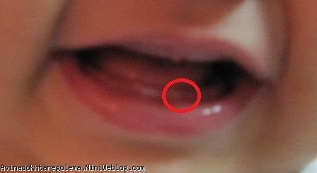 دندون دومی که تو پیله هست با دایره قرمز رنگ مشخص شده...