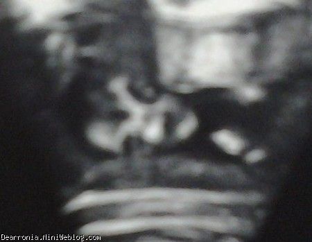 این اولین عکسیه که از من گرفته شده اوم با دستگاه سونوگرافی. همش 4 ماهمه. شبیه مریخی هام