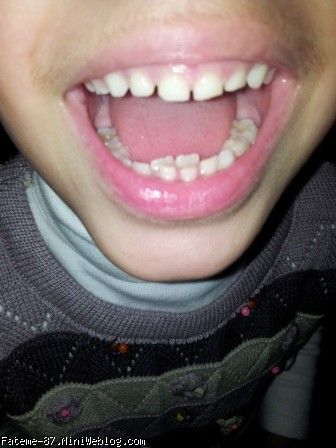 افتادن دندان