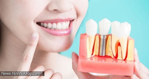 با مراحل مختلف ایمپلنت دندان آشنا شوید!