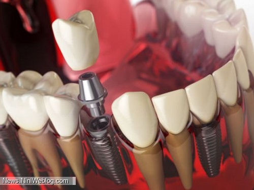 ایمپلنت دندان فوری چیست و چه مزایایی دارد؟
