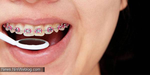 مرتب کردن دندان کودکان با ارتودنسی