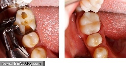 تشخیص و درمان حفره دندانی