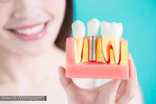 به چه دلایلی کاشت دندان با ایمپلنت در سنگاپور پیشنهاد نمیشود؟