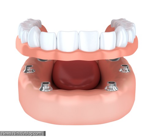 اوردنچر دندان چیست ؟ ( + 10 مزایا و 7 معایب مهم )