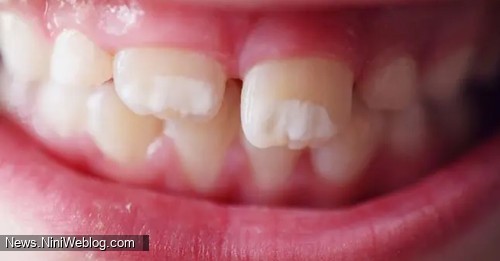 تشخیص و مراحل درمانی لکههای سفید در دندانپزشکی کودک