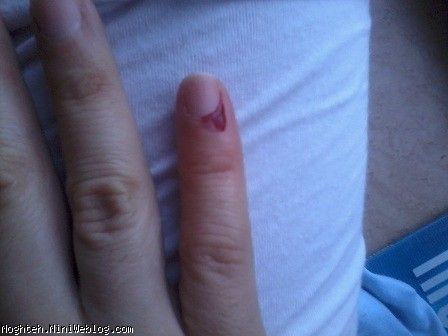 بعد ار دو روز هنوز دستم خون میاد جاش درد می کنه انگشتم رو نمی تونم تکون بدم 