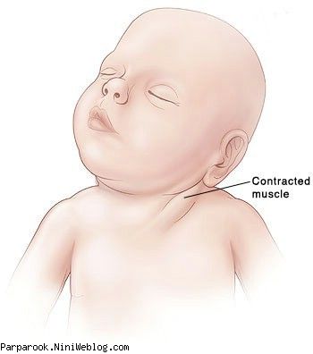 تورتیکولی یا کجی گردن نوزاد چیست؟ 