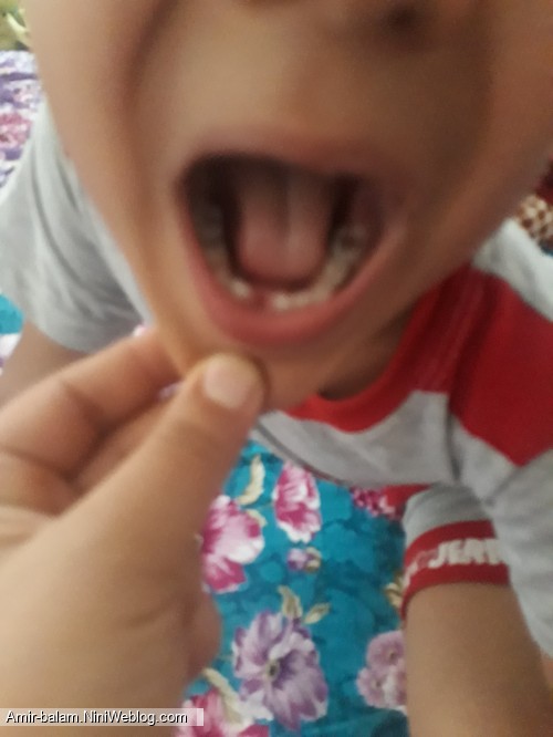 افتادن اولین دندان شیری