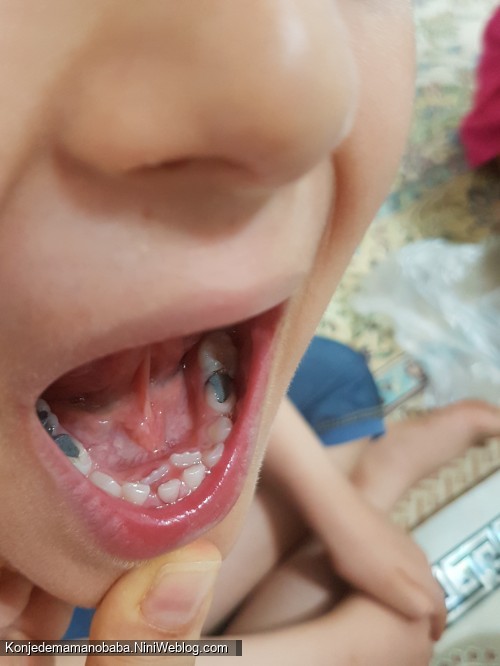 اولین دندان دائمی