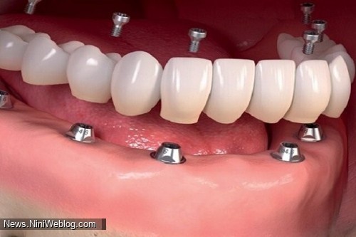 چه افرادی بهترین گزینه برای ایمپلنت دندان هستند؟