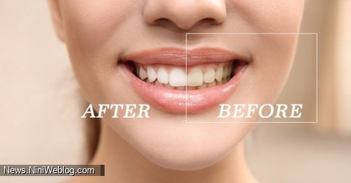 انواع روش‌های سفیدکردن دندان