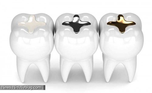انواع مواد برای پرکردن دندان