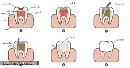 مراحل پر کردن دندان