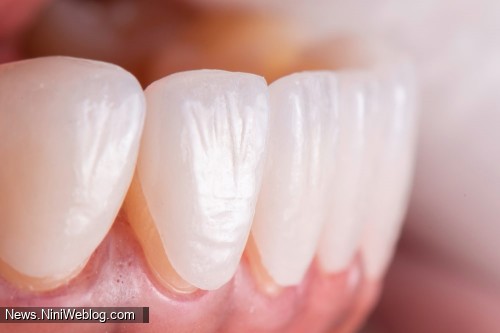 رعایت کردن بهداشت دهان و دندان ها تاثیر به سزایی بر طول عمر لمینت دندان دارد.