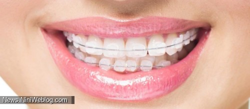 بریس های فلزی دندان