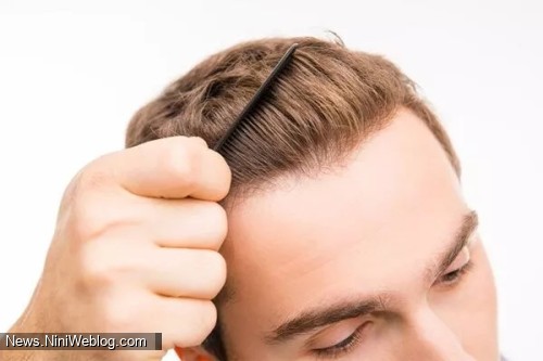 عوارض کاشت مو چیست؟