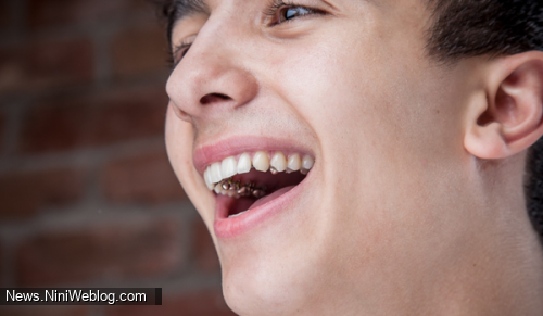 مراقبت از ارتودنسی پشت دندانی