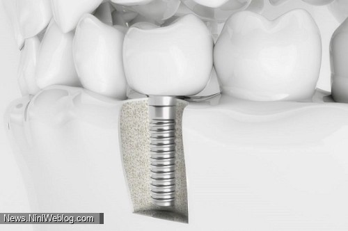 هزینه ایمپلنت کامل دندان‌ها
