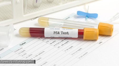 مقدار نرمال آزمایش free psa+آزمایش در منزل
