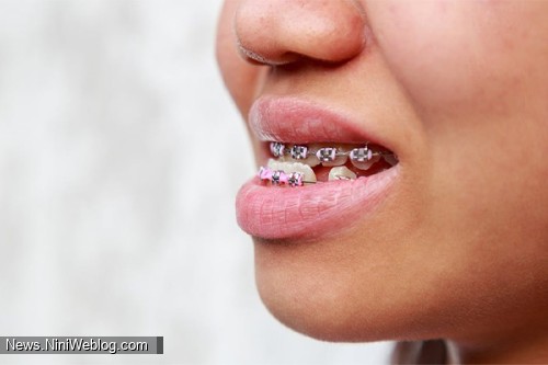 درمان جلو بودن فک پایین با ارتودنسی بدون جراحی