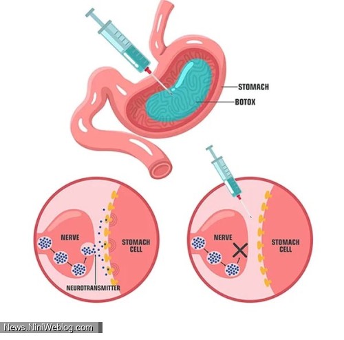 بوتاکس معده