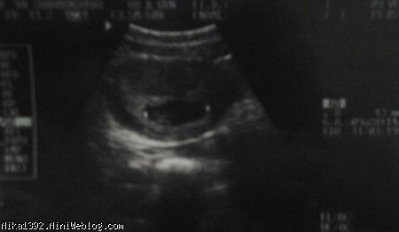 اولین سونو در 3ماهه اول بارداری