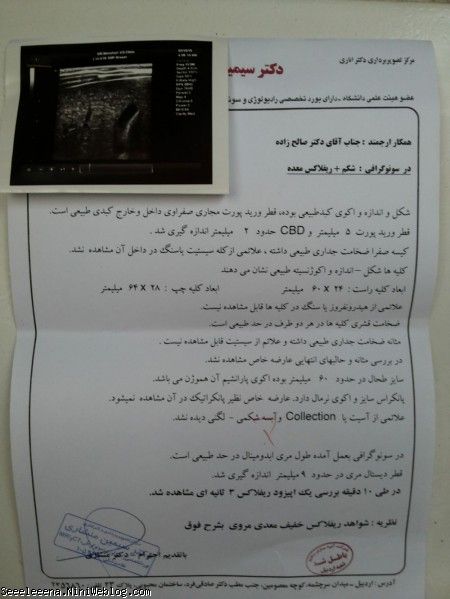 رفلاکس معده پرنسس